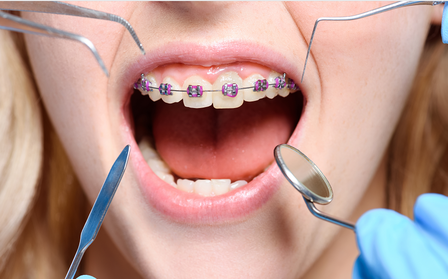 牙齿矫正会不会导致牙齿松动？