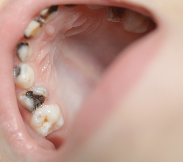 儿童牙齿蛀牙