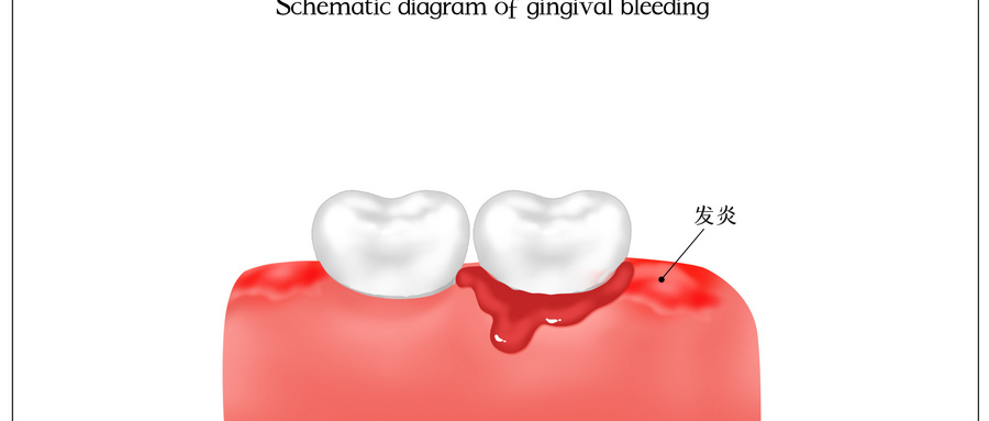口腔溃疡和牙龈出血的自我治疗方式.jpg