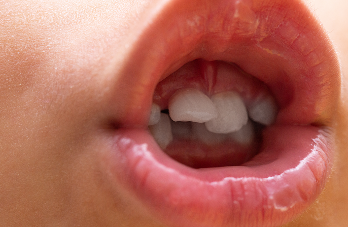 乳牙根管治疗会影响恒牙发育吗？.png