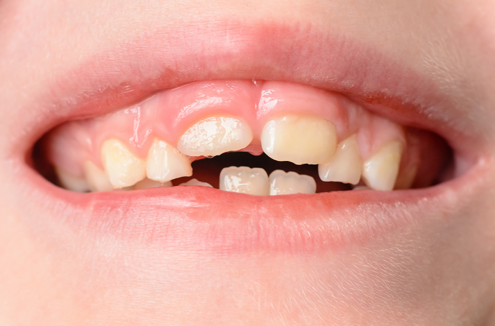 儿童牙齿畸形