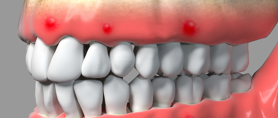 牙周病有哪些危害？牙周炎的日常保健方法.jpg