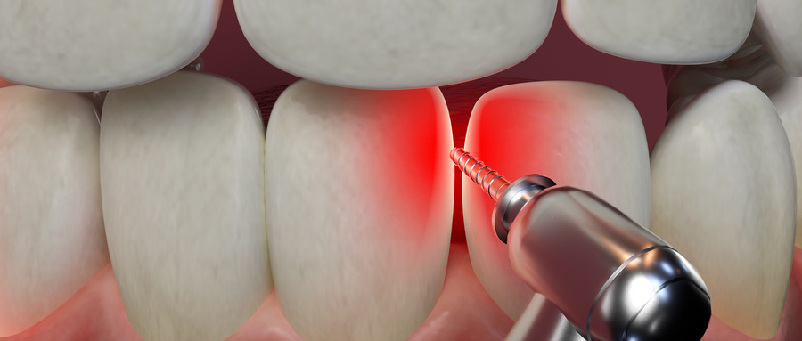 牙周炎怎么治疗最有效？