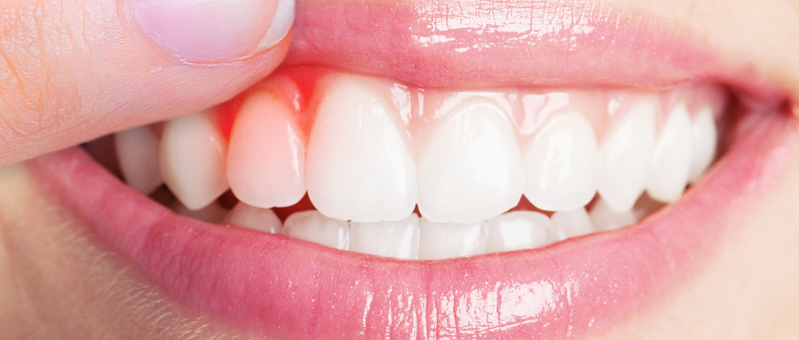 牙周炎的症状表现有哪些？注意这几点！