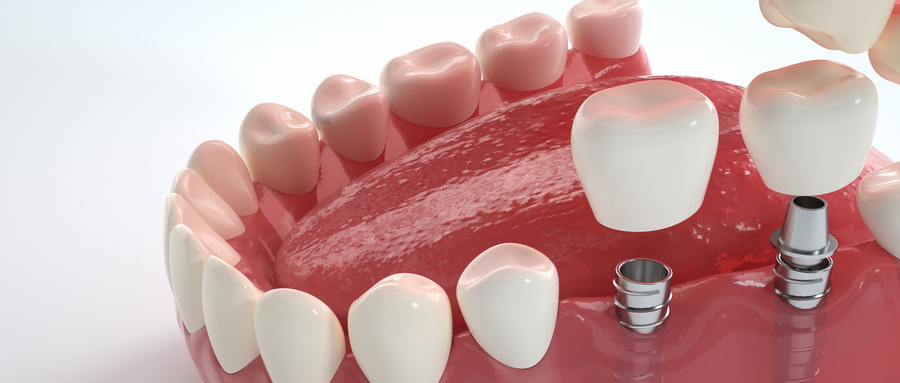 牙缺失有几种修复方式？.jpg