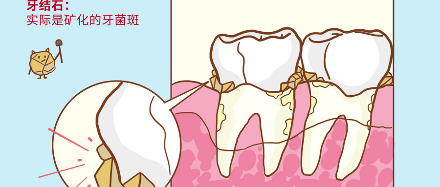 牙结石治疗