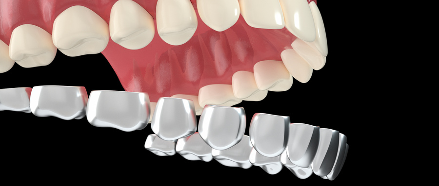 佩戴牙套期间会有龋齿吗？牙齿矫正期间应该如何护理牙齿？.jpg