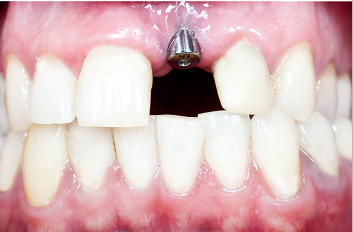 种植牙和原生牙有什么区别？
