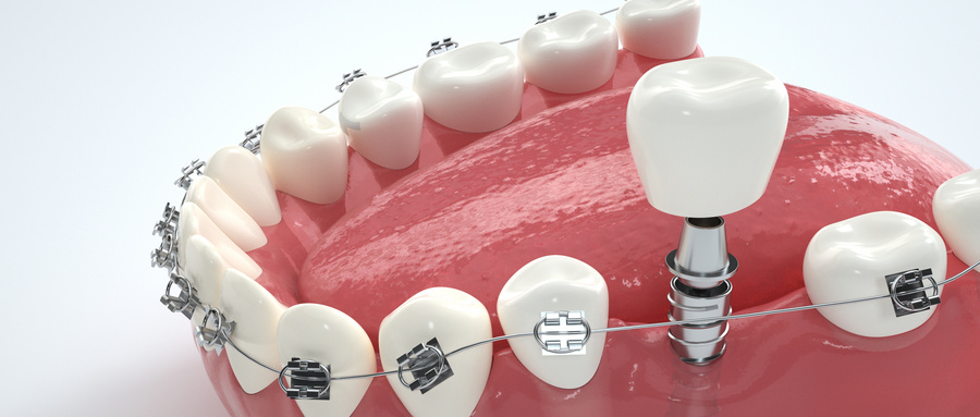 牙齿矫正期间需要注意的事项？