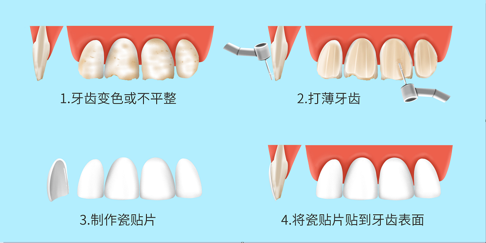 牙齿贴面操作流程