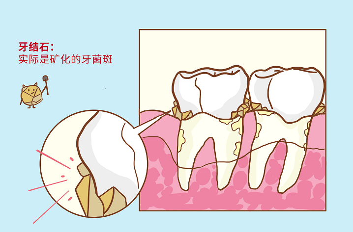 牙结石图片介绍.png