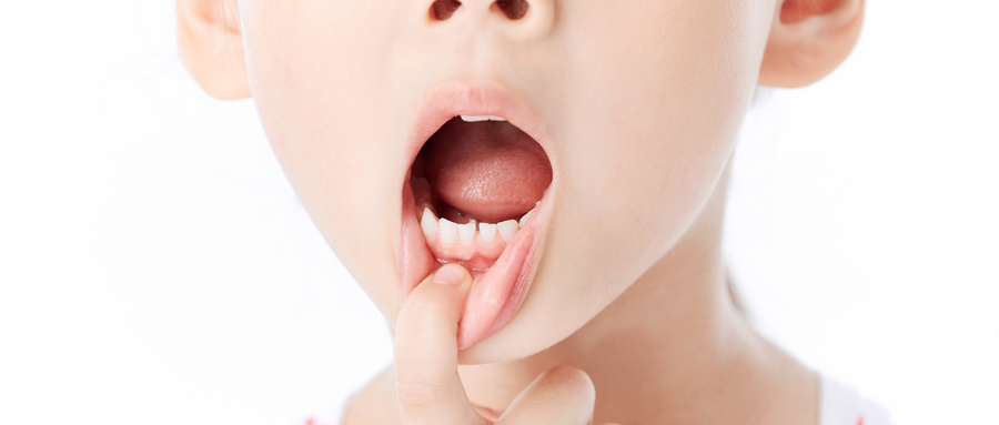 儿童龋齿需要治疗吗？