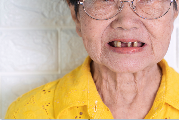 长期缺牙不补，你可能会更显老！.png