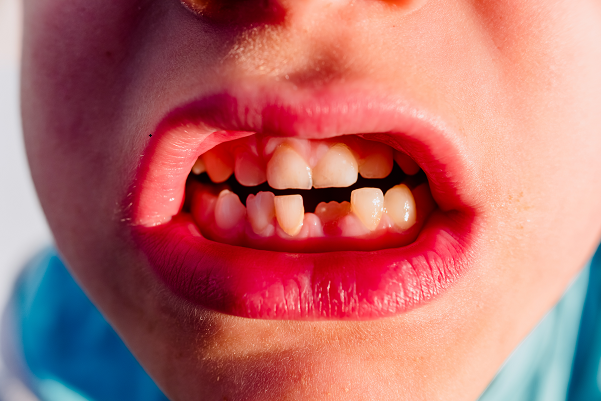 口腔习惯对孩子颜面影响有多大？.png