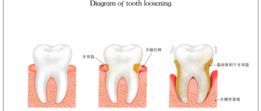 牙齿松动有什么办法恢复？