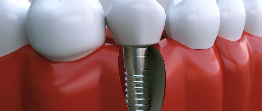 拔牙后长期放任不管缺失牙齿，其他牙齿会遭殃的.jpg